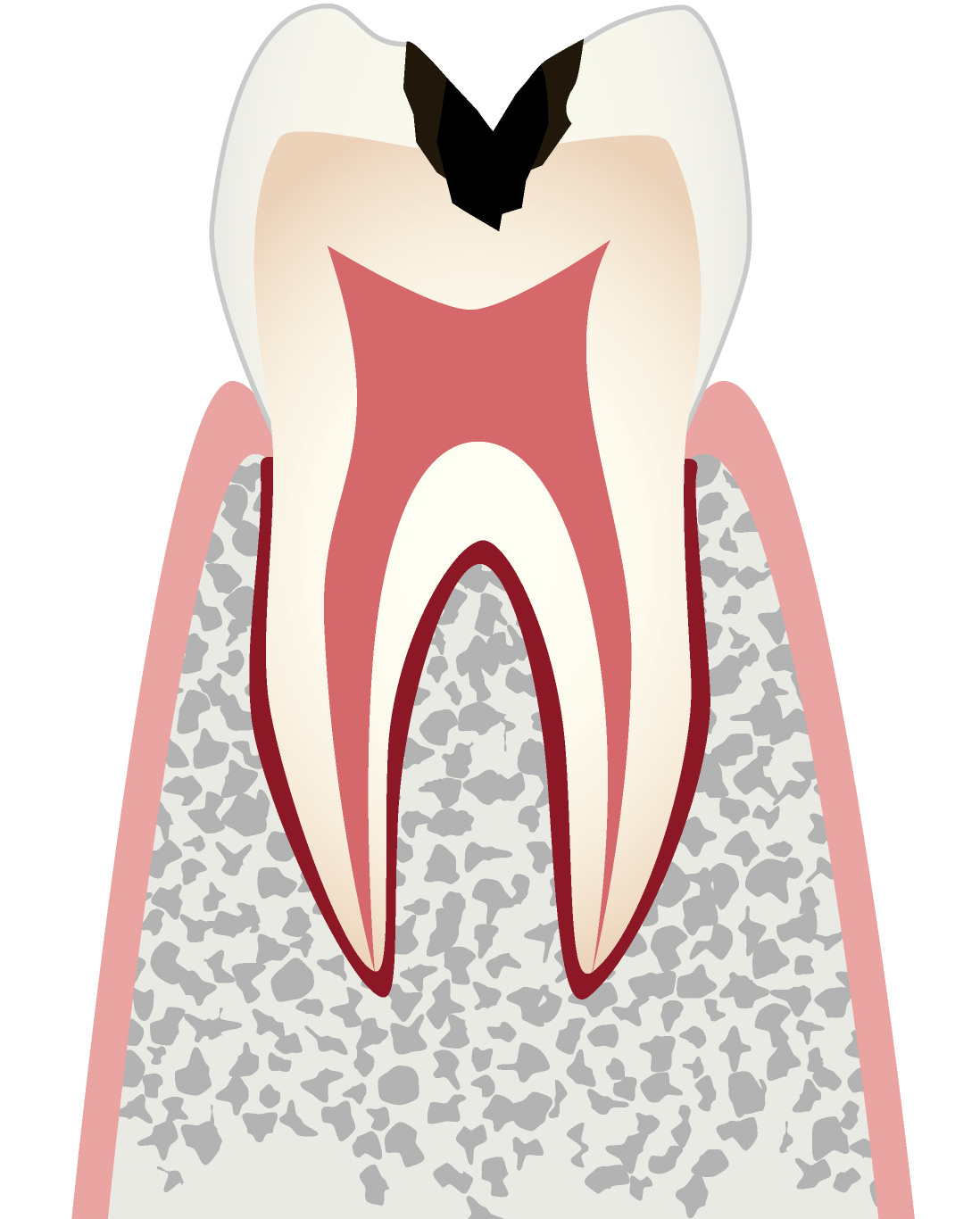 C2 象牙質のむし歯
