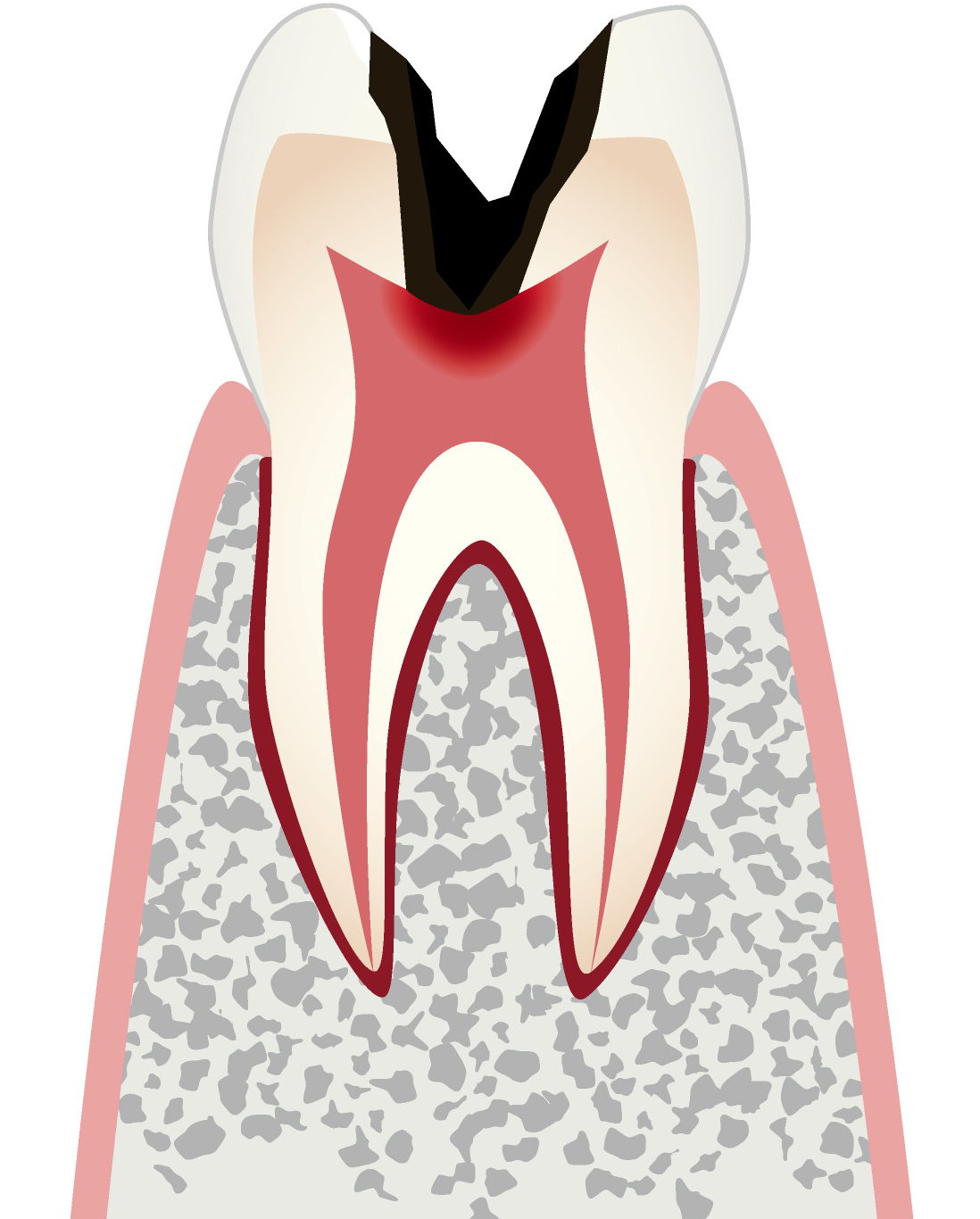 C3 歯髄のむし歯