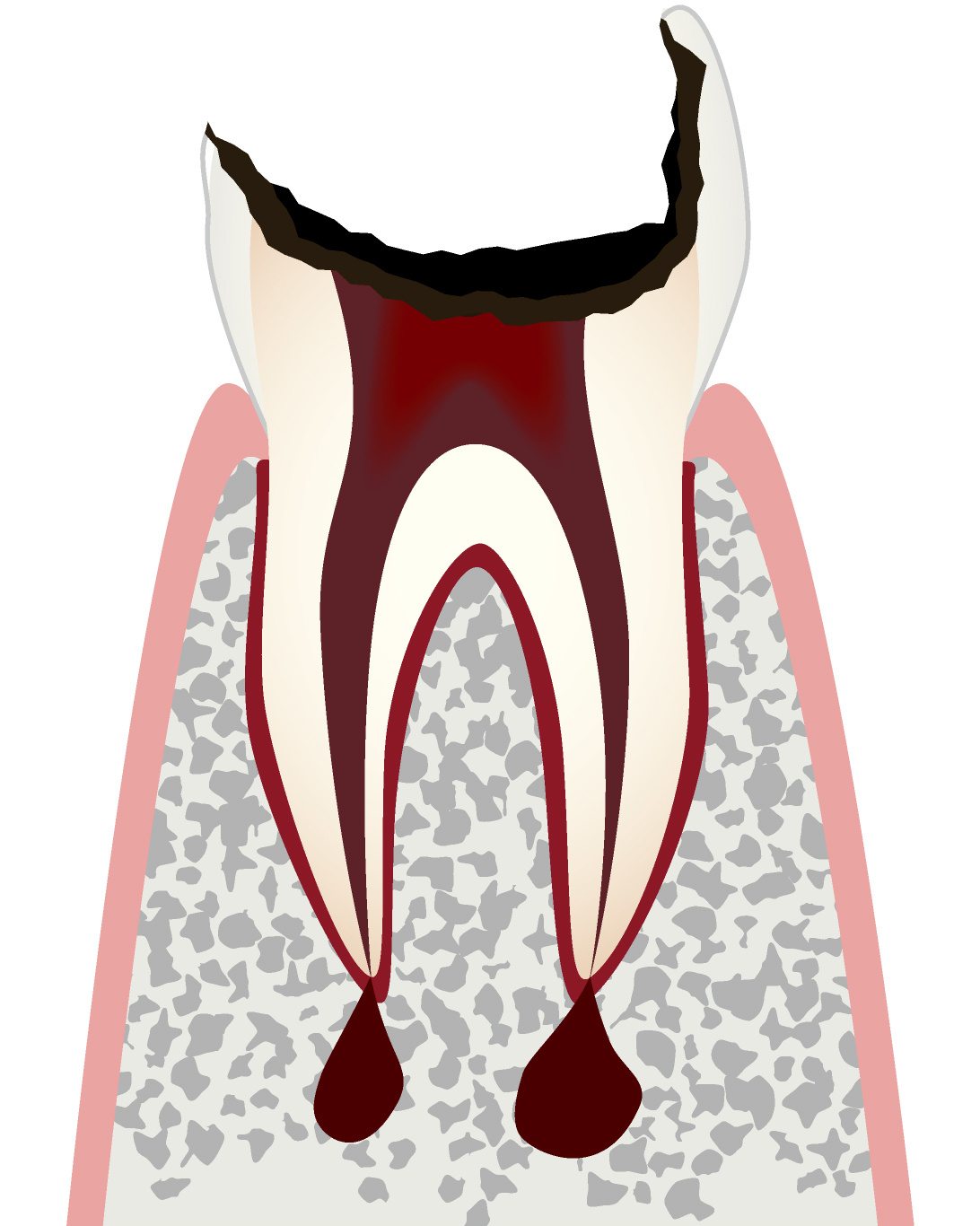 C4 歯髄が壊死したむし歯