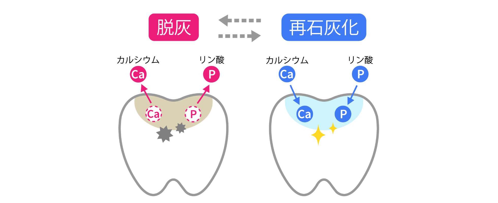 むし歯の原因・メカニズム