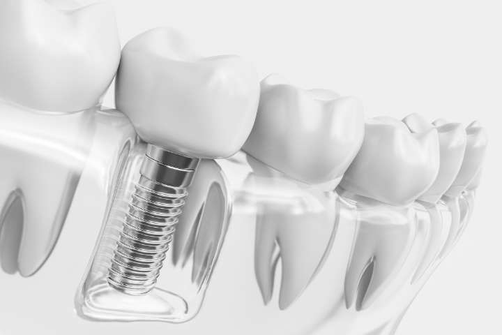 歯科用インプラント治療