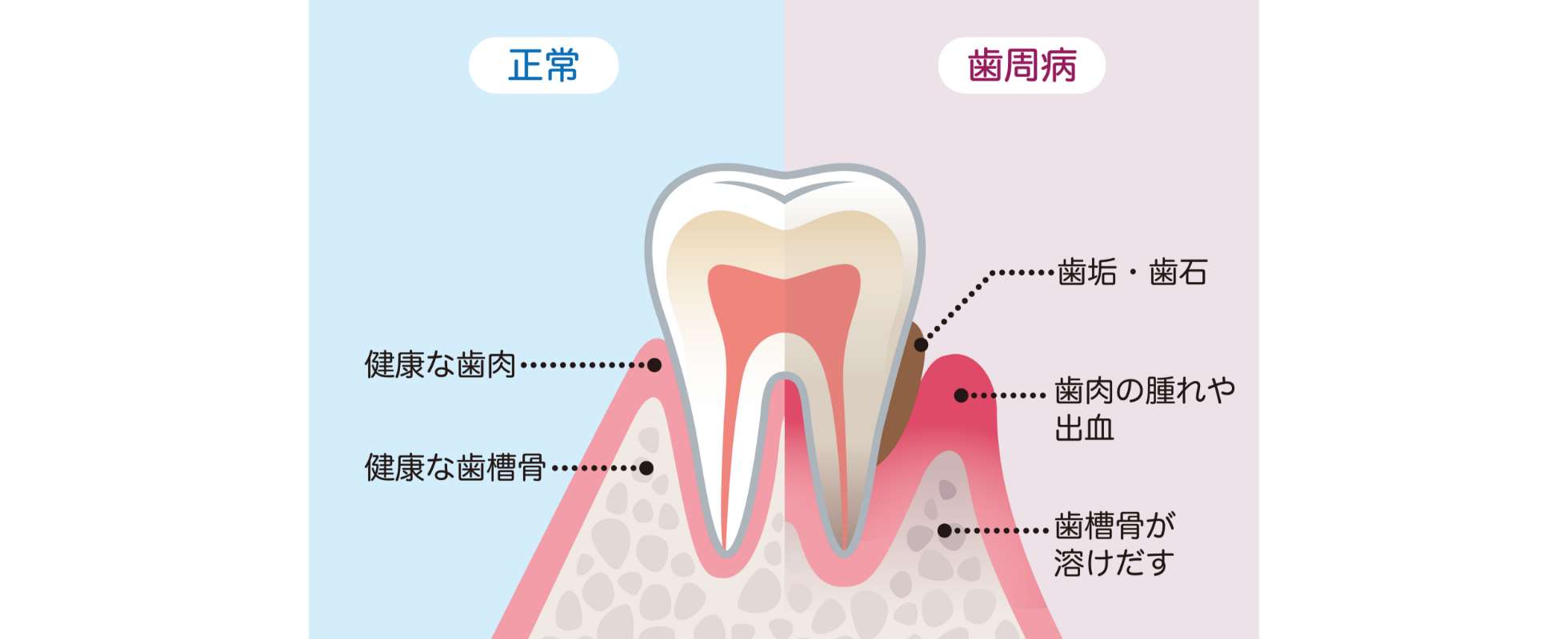 歯周病とは