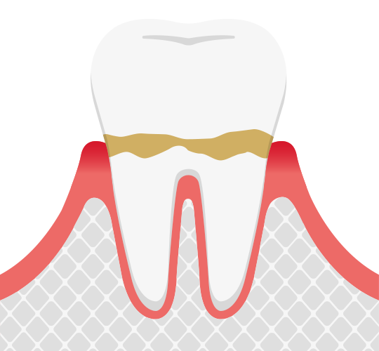 歯肉炎