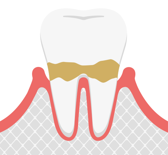 歯周炎（軽度）
