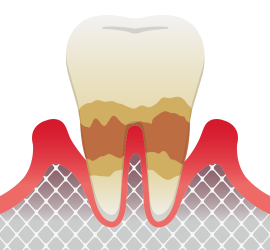 歯周炎（中等度）