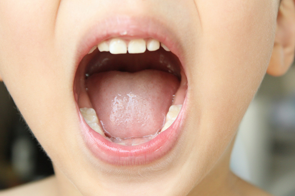 嚥下時に舌で前歯を押さない